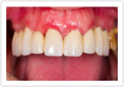 Porcelain Crowns Dental Bridges After at Port Orchard Dental Care