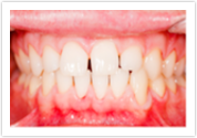 Teeth Whitening Dental Veneers_After at Port Orchard Dental Care