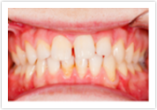 Teeth Whitening Dental Veneers_Before at Port Orchard Dental Care